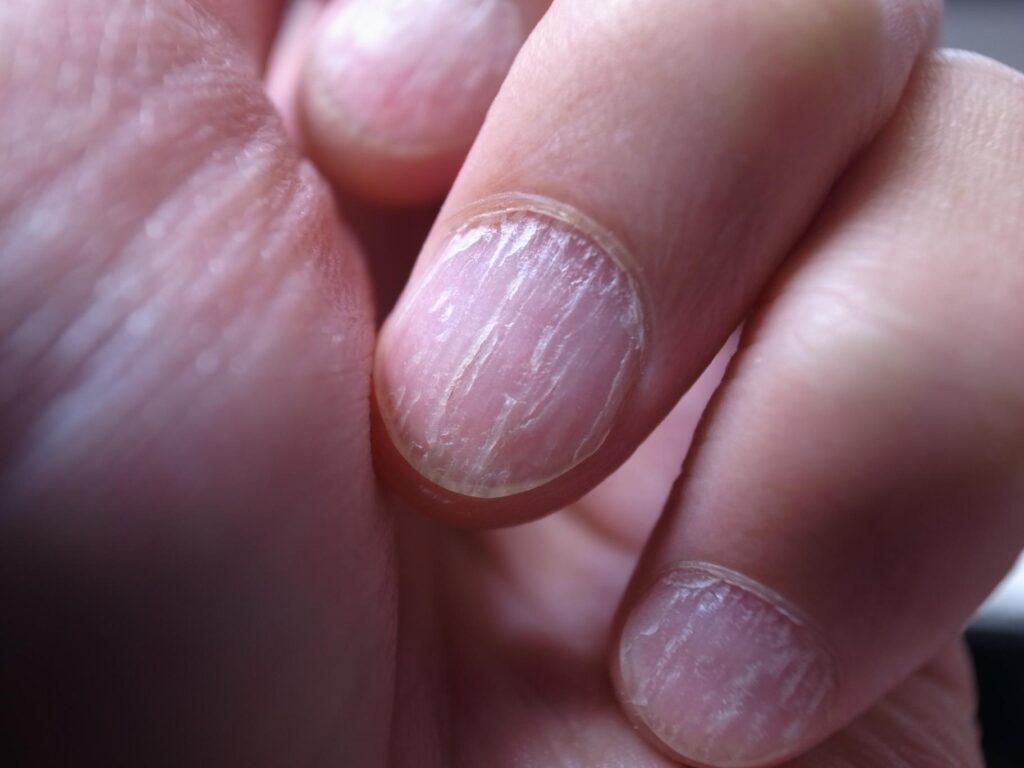 signs showing unhealthy and weak nails