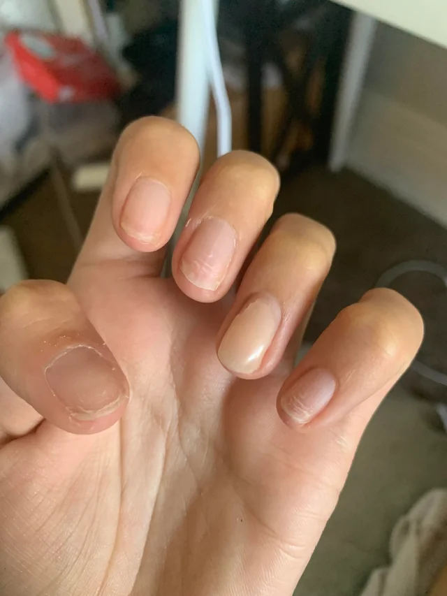 a weak and damaged nail