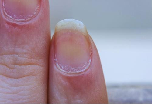 How do you Remove Yellow Stains from Nails